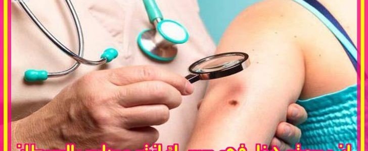 الشامات الموجوده فى الجسم تسبب السرطان الشامات الموجوده فى الجسم تسبب السرطان بنسبة 50 فى المائة | شبكة عرب مصر