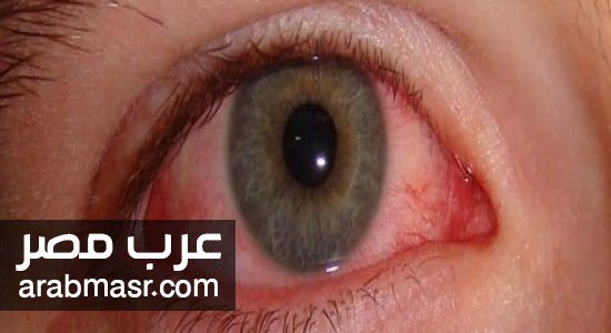 للتخلص من التهاب العين للتخلص من التهاب العين طريقة سهلة ومفيده للعين تعرف عليها الان