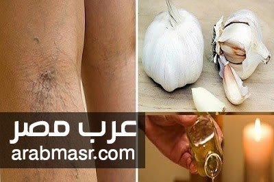 التخلص من الدوالي التخلص من الدوالي نهائيا بوصفه منزلية بسيطة جدا تعرف عليها الان